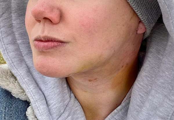 عوارض احتمالی لیفت صورت و روش های مقابله با آن ها