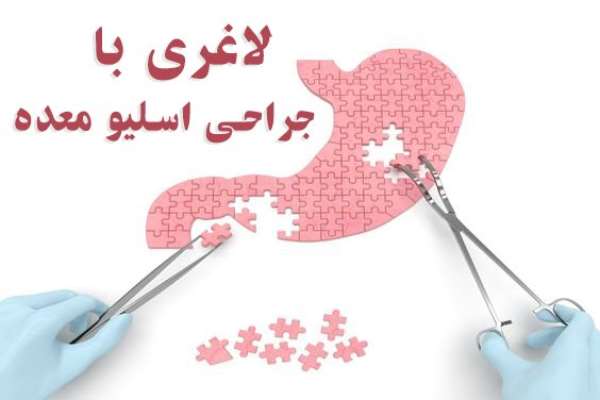 5 دلیل مهم برای انتخاب لاغری با جراحی اسلیو معده
