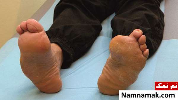 قطع عضو مبتلایان به دیابت