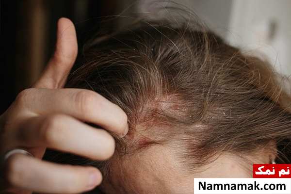 علت درماتیت سبورئیک