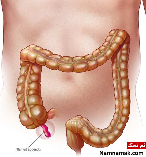 آپاندیسیت
