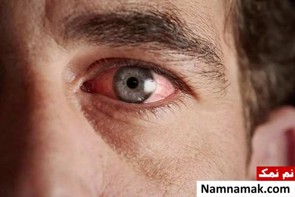 علت چروک و جمع شدن سفیدی چشم تا نحوه درمان