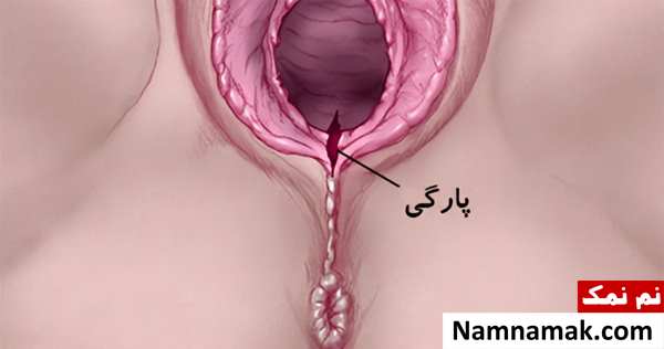 پاره شدن واژن