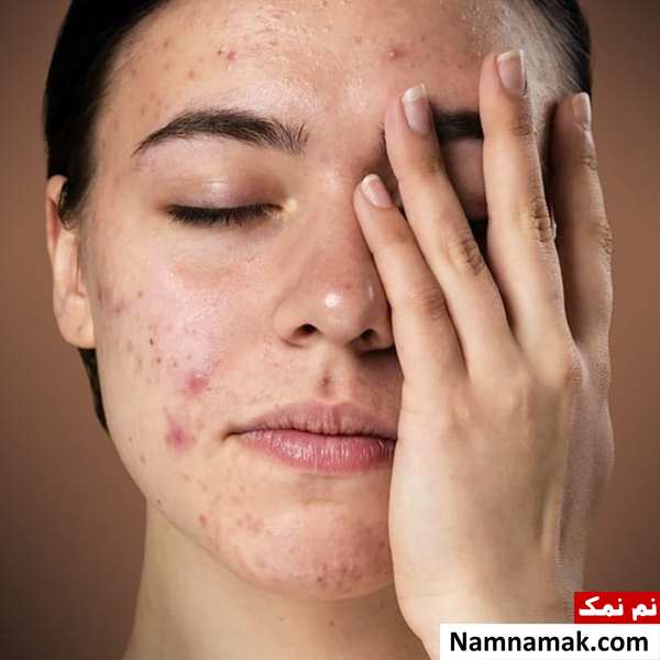 از بین بردن جوش صورت در یک روز