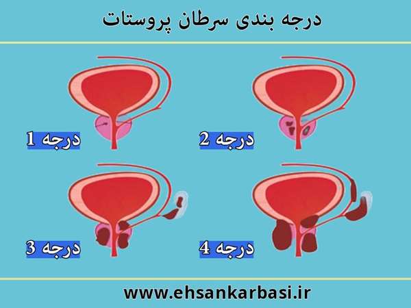 درجه بندی سرطان پروستات