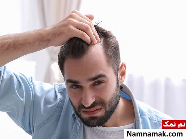 ریزش مو مردان