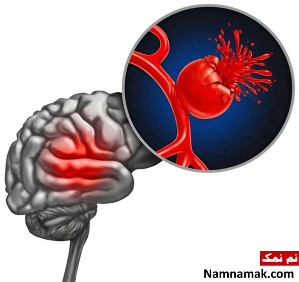آیا آنوریسم مغزی باعث مرگ میشود؟