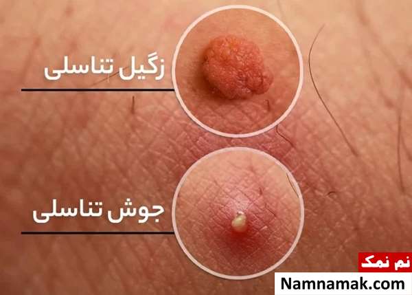زگیل تناسلی و جوش