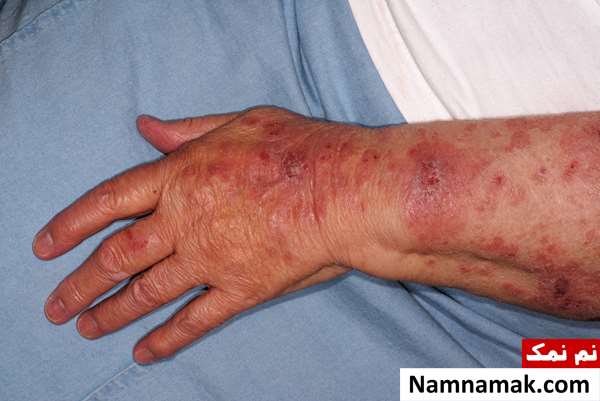 بیماری سلیاک چیست و چه علائمی دارد؟