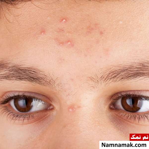 علت زیاد شدن جوش صورت