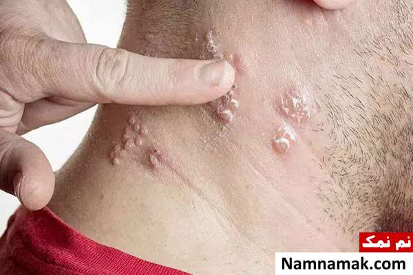 بیماری زونا تا چه مدت واگیر دارد؟ بیماری زونا تا چه مدت واگیر دارد؟