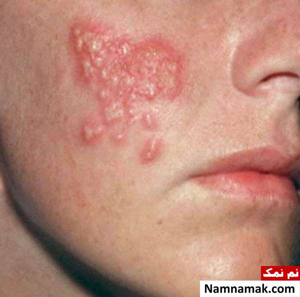 بهترین آمپول برای درمان زونا چیست؟ بهترین آمپول برای درمان زونا چیست؟