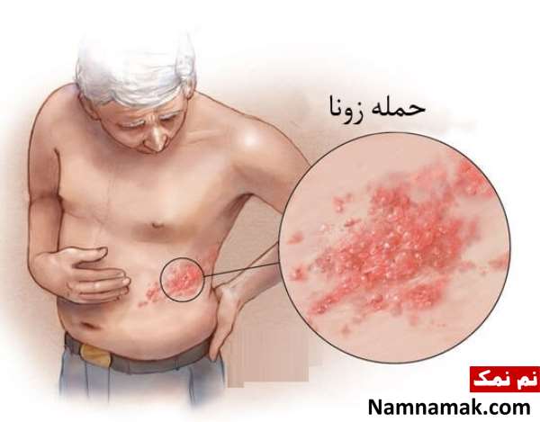 آیا زونا خطرناک و کشنده است؟