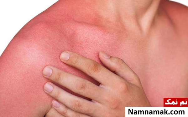 علائم آفتاب سوختگی