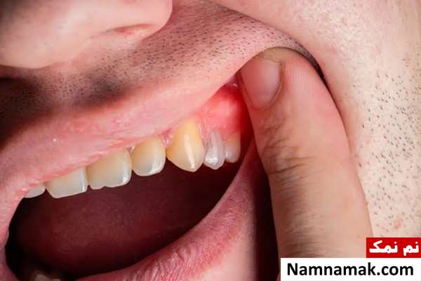 طرز تهیه دهانشویه خانگی برای عفونت لثه