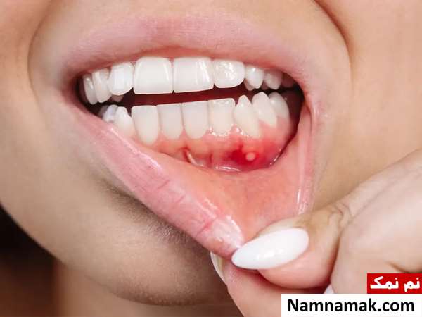 طرز تهیه دهانشویه خانگی برای عفونت لثه