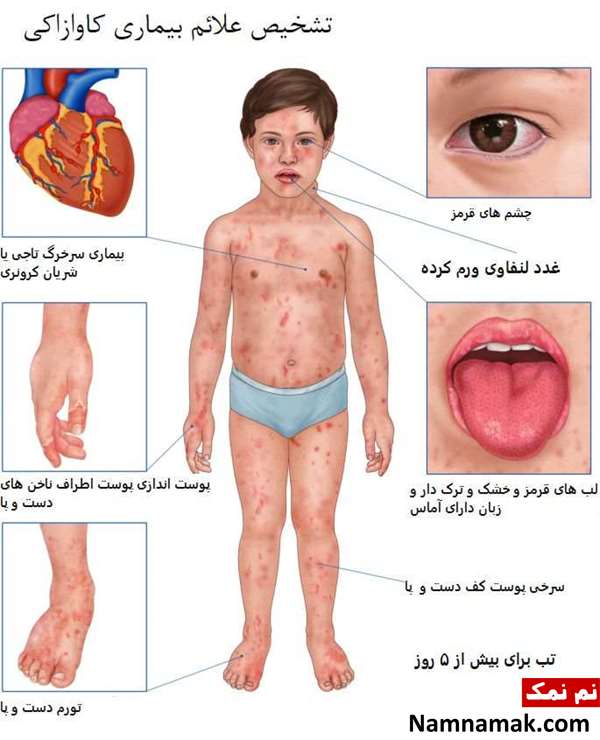 آیا بیماری کاوازاکی خطرناک است و باعث مرگ میشود؟