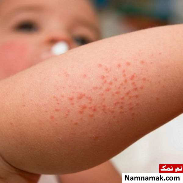 آیا بیماری کاوازاکی خطرناک است و باعث مرگ میشود؟
