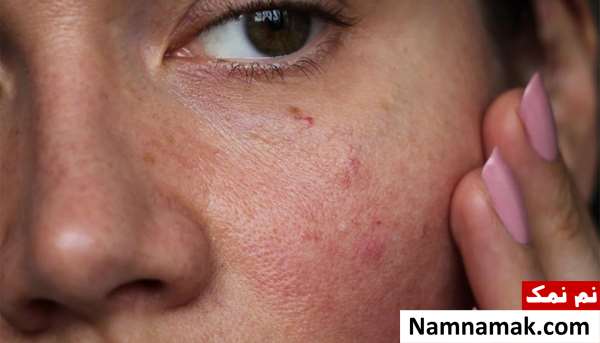 چگونه بفهمیم پوستمان حساس است؟