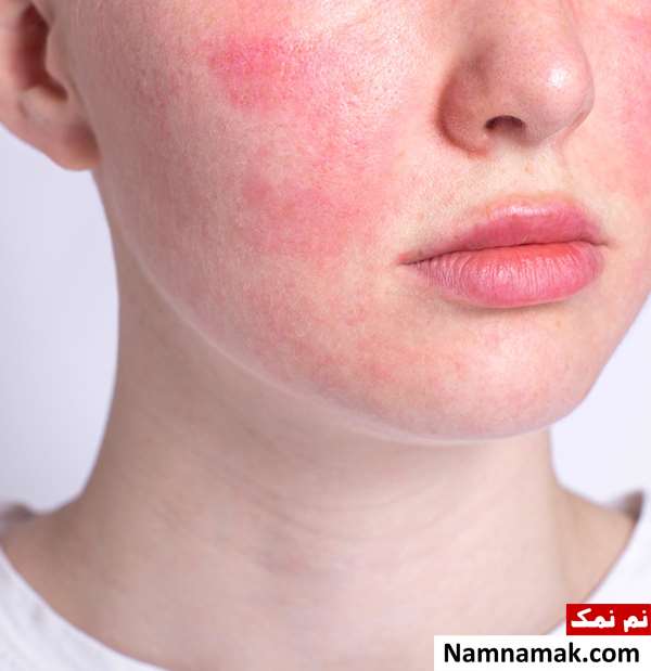 چگونه بفهمیم پوستمان حساس است؟