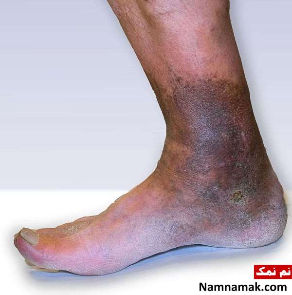 نارسایی مزمن وریدی