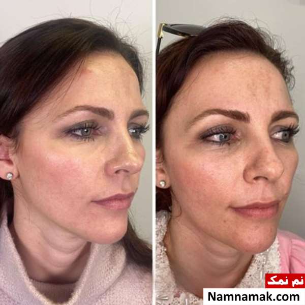 عکس قبل و بعد تزریق پروفایلو