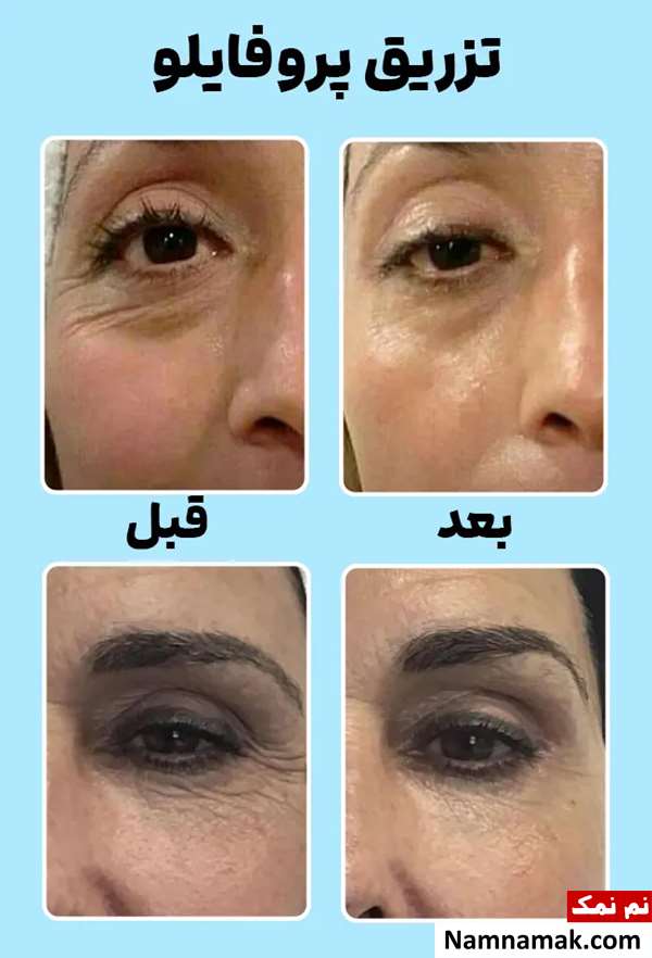 عکس قبل و بعد تزریق پروفایلو