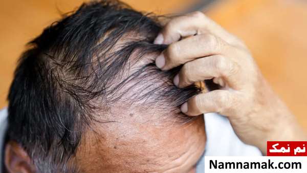 خوراکی باعث ریزش مو