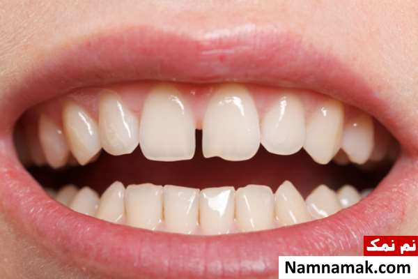 دیاستم دندان چیست و چگونه درمان می شود؟