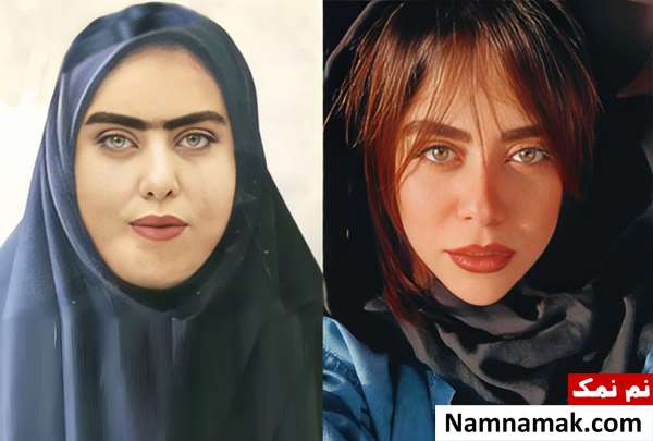 الهام اخوان قبل از عمل