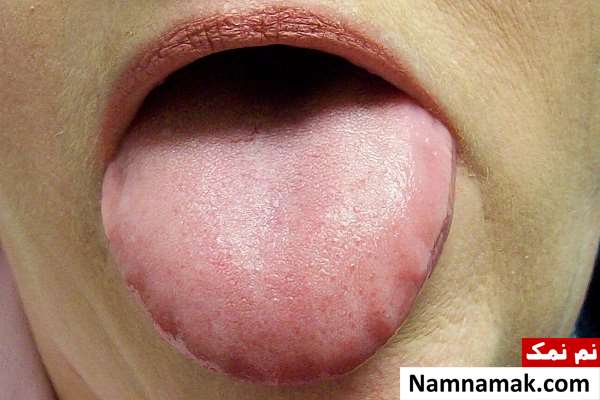 تشخیص بیماری از روی زبان در طب سنتی