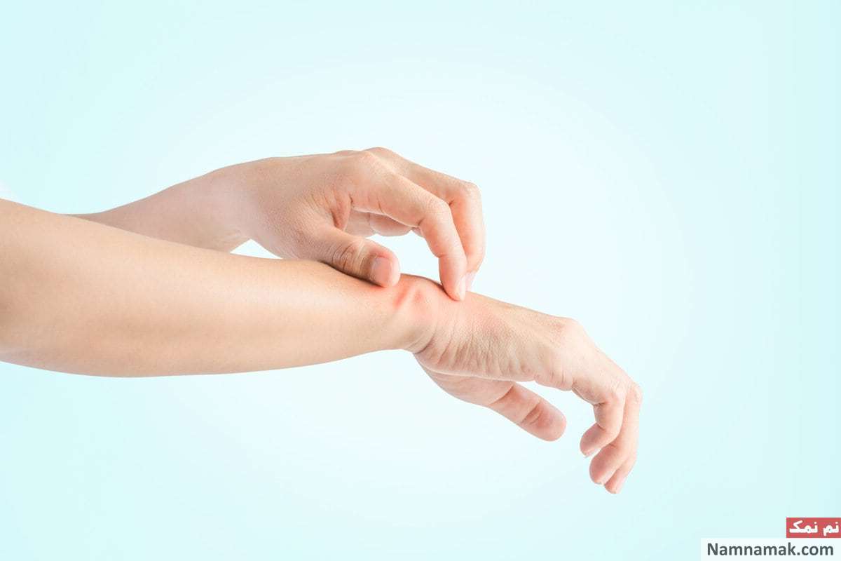 قارچ پوستی واگیردار
