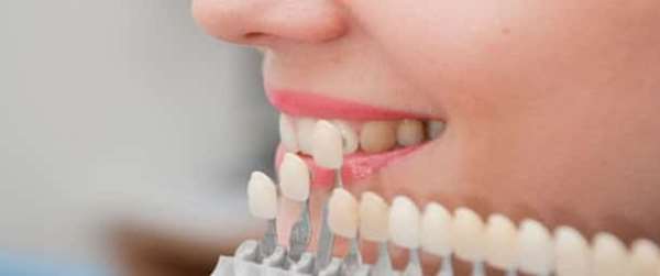 لمینت دندان چقدر طول میکشد و طول عمر آن چقدر است؟