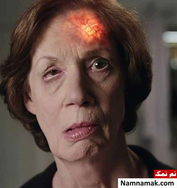 علائم سکته مغزی و پیشگیری از آن