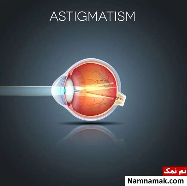 آستیگمات چشم