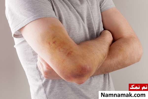 آیا پایین بودن پلاکت خون نشانه سرطان است؟ آیا پایین بودن پلاکت خون نشانه سرطان است؟