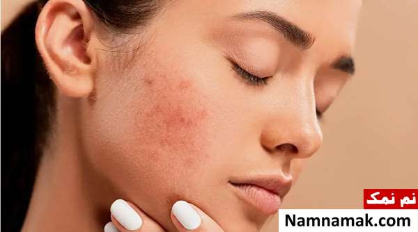فواید اهدای خون برای جوش و آکنه