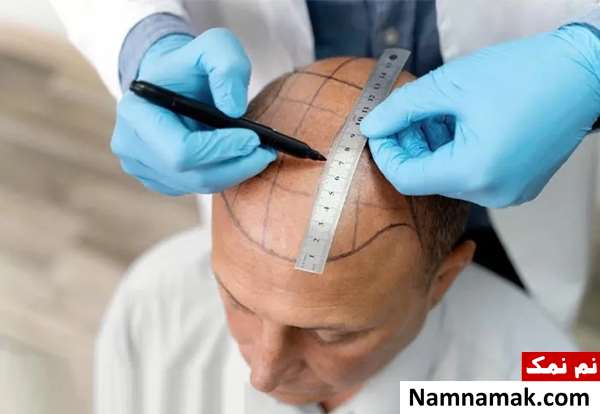 بهترین روش های کاشت مو با تراکم بالا بهترین روش های کاشت مو با تراکم بالا