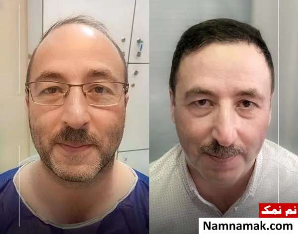 بهترین روش های کاشت مو با تراکم بالا بهترین روش های کاشت مو با تراکم بالا