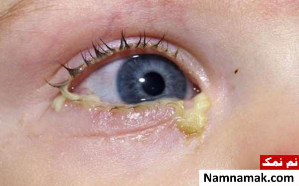 چرک چشم در صبح چرک چشم در صبح