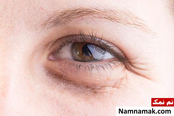 قرص آهن برای سیاهی دور چشم