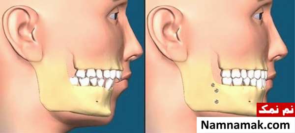 عمل جراحی فک پایین