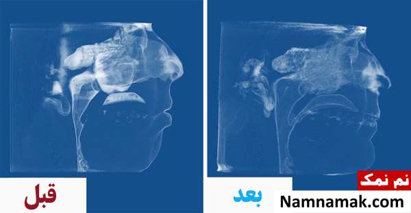 عکس قبل و بعد جراحی فک و تصاویر تغییر چهره