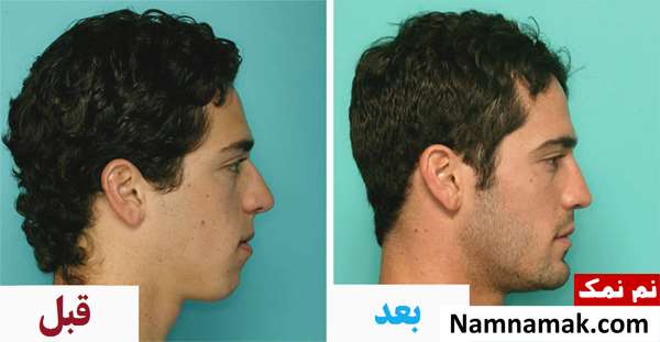 عکس قبل و بعد جراحی فک و تصاویر تغییر چهره