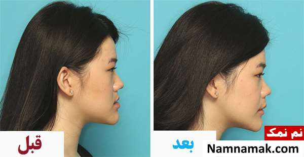 عکس قبل و بعد جراحی فک و تصاویر تغییر چهره
