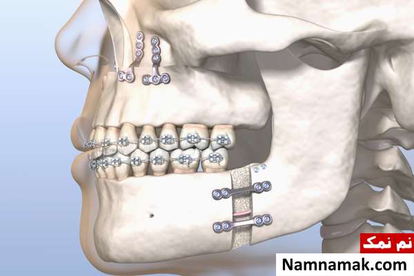 آیا جراحی فک خطرناک است؟
