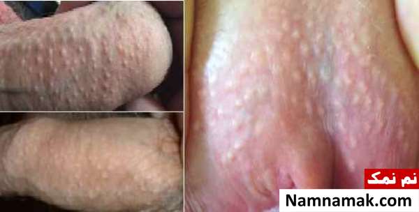 بیماری های پوستی دستگاه تناسلی مردان