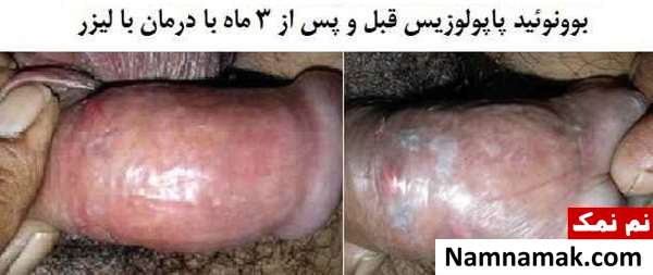 بیماری های پوستی دستگاه تناسلی مردان