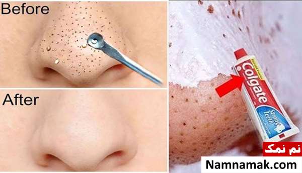 کرم رفع دانه های سیاه روی بینی