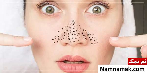 آموزش تخلیه جوش سر سیاه بینی در منزل